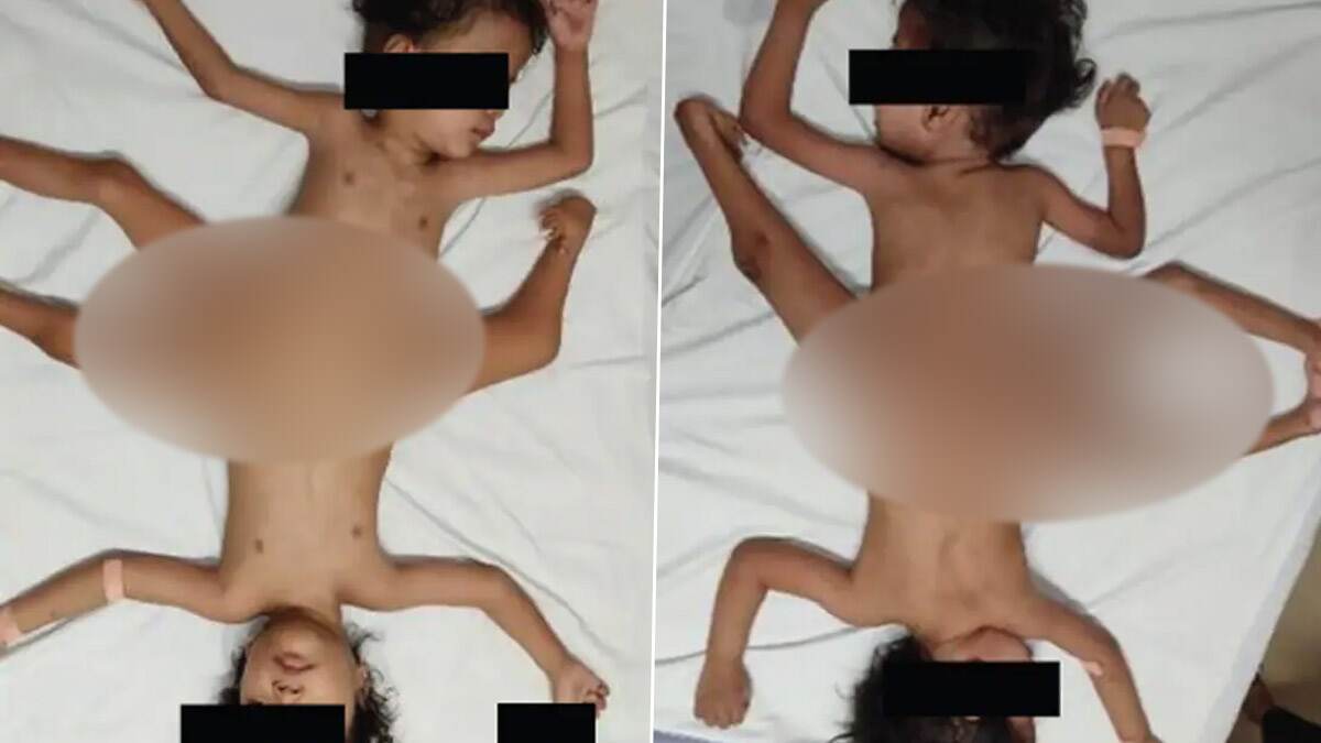 Extremely Rare Conjoined Twins Born: இந்தோனேசியாவில் நடந்த அரிய சம்பவம்.. 4 கைகள், 3 கால்களுடன் ஒட்டிப்பிறந்த இரட்டையர்கள்..!