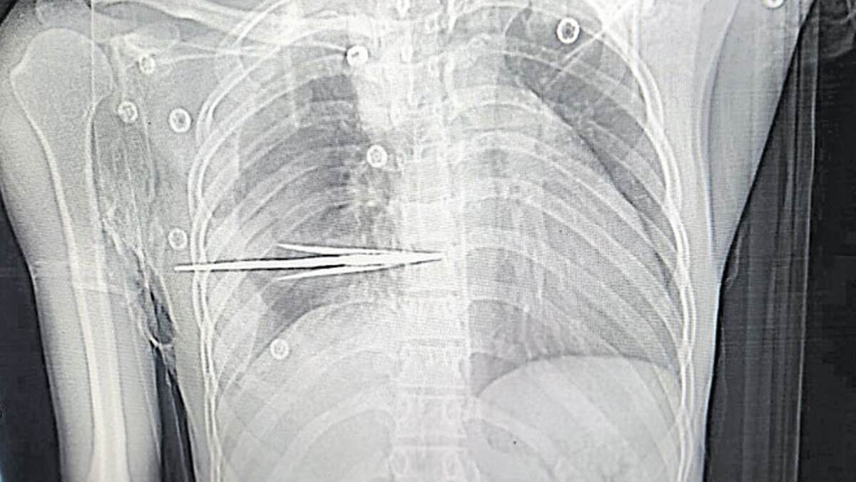 NIMS Doctors Save Child Life: இதயத்திற்கு அருகில் சிக்கிய அம்பு; சிறுவனின் உயிரை காப்பாற்றிய மருத்துவர்கள்.. நெகிழ்ச்சி செயல்.!