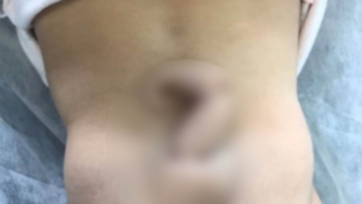 Baby Born With Tail: வாலுடன் பிறந்த அதிசய குழந்தை.. ஒட்ட நறுக்கி அனுப்பிய மருத்துவர்கள்..!