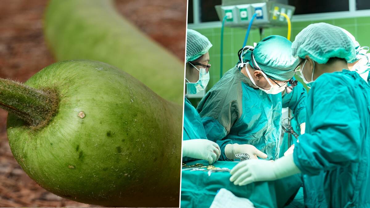 Doctors Remove 16-Inch Bottle Gourd from Man's Rectum: ஒரேயொரு அறுவை சிகிச்சை.. வயிற்றிலிருந்து 16-இன்ச் சுரைக்காயை அகற்றிய மருத்துவர்கள் குழு!