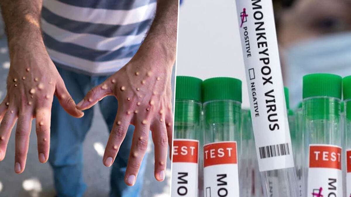 Mpox in India: இந்தியாவில் பதிவான குரங்கம்மை பாதிப்பு.. அறிகுறிகள் மற்றும் சிகிச்சை முறைகள் பற்றி தெரியுமா?!