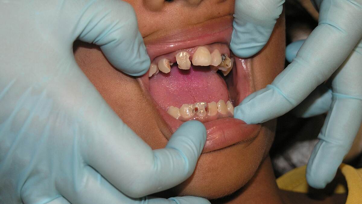 Dental Hygiene: குழந்தைகளின் பல் சொத்தைக்கான காரணம் என்ன? தவிர்க்க வேண்டிய உணவுகளின் லிஸ்ட் இதோ.!