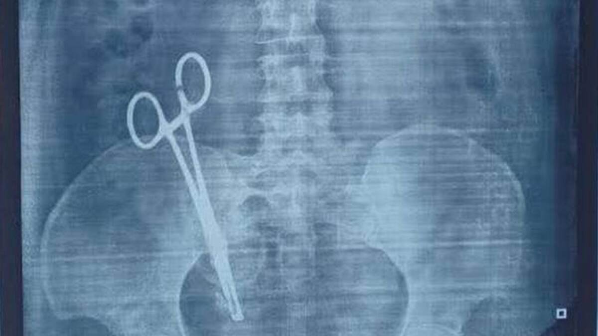 Surgical Scissor: 17 ஆண்டுகளாக பெண்ணின் வயிற்றில் இருந்த கத்தரி; பிரசவ சிகிச்சைக்கு பின் கொடுமை..!