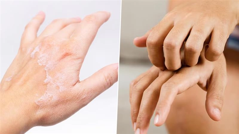 Health Tips: குளிர்கால சரும நோயால் அவதிப்படுறீங்களா?.. தடுப்பது எப்படி?.. இந்த விஷயத்தில் கவனம்.!