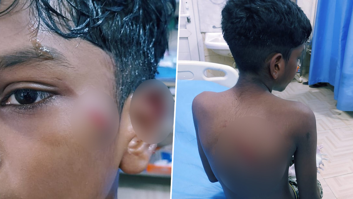 Dog Attack in Chennai: ஒரேநாளில் இருவேறு துயரங்கள்.. சிறார்களை கடித்து குதறிய நாய்கள்.. சென்னையில் அடுத்தடுத்து அதிர்ச்சி.!