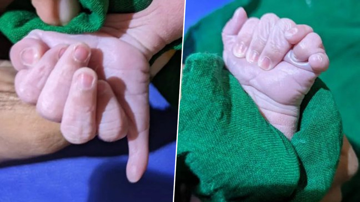 Baby Boy Born with 25 Fingers: கை-கால்களில் 25 விரலுடன் பிறந்த அதிசிய குழந்தை; இன்ப வெள்ளத்தில் பூர்த்திப்போன குடும்பம்.!